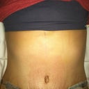 4 days post op