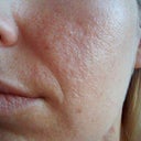 7 weeks after 2nd treatment left cheek