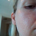 7 weeks after 2nd treatment right cheek