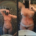 5 days PO.  Very Very swollen! PS promises it will b flat when all swelling is gone.