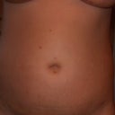 after- one week- puffy- improved