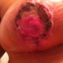 Day 14 Right nipple after some necrotic tissue removed. Barely noticable.