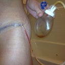 6 Days post op.