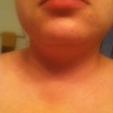 My chin :( hoping it looks better after surgery