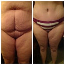 Here is a before and after (3 weeks post op) I'm thrilled!