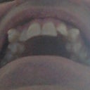 Trays no.17 - upper jaw