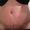 Incision Up close - 4 weeks PO