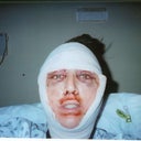 Day# 1 after surgery