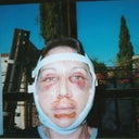 Day# 3 after surgery