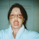 Day# 5 after surgery