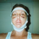 Day# 6 after surgery