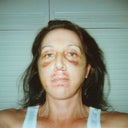 Day# 7 after surgery