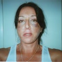 Day# 8 after surgery