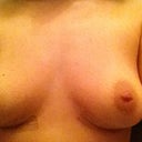 9 days post surgery