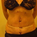 1 day after TT.. Not really happy with results now :(