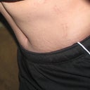 This is three weeks Post op