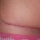 Right side 6 weeks PO