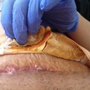 After 2 weeks from surgery I was healing very well and was put off meds. Unfortunately i had gotten an Infection 4 days after. Infection is getting better as I clean it and change bandages every day.