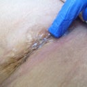 Cleaning the incision