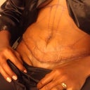 Tummy right after surgery