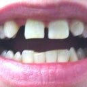 Before Treatment- 8-20-12