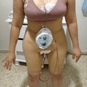 Front of me after surgery with garment on