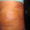 2 week PO. hematoma close up.