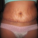 2 week PO. hematoma on L side.