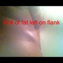 This is the roll on my flank that was to b lipo
