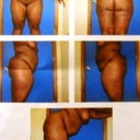 Morning of Surgery..Photos taken by Surgical Assistant Sept 17, 2010