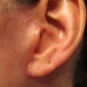 Left ear with bubble and pixy ear
