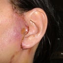 Left ear after surgery
