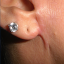 Right ear with Keloid
