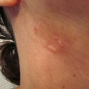 Scars on neck