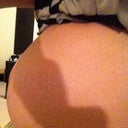 24 days pre-op. I look pregnant but I can assure you I'm not!