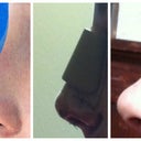 3D Consultation Pictures, Day of Surgery, Day of Cast Removal