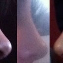 Week 1 After Surgery
