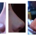 Week 2 After Surgery