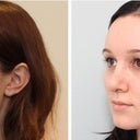 LEFT 3/4: Before and after (right after cast removal)