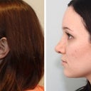 LEFT PROFILE: Before and after (right after cast removal)