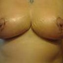 3wks Post Op