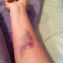 Week 1 IV impressive bruise