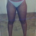 Before Surgery- front view