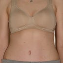 8 weeks post op