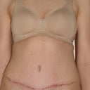 8 weeks post op
