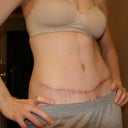 8 weeks post op