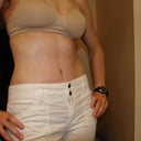 8 weeks post op.  Size 4 capris that I have worn since last summer...except this time, my belly isn't tucked in!