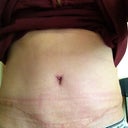 My Scar 4 weeks post op. I have some marks from my jeans and the compression garment, but my scar is healing nice.