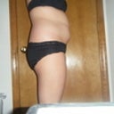 Side view. 4 days before surgery.
