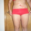 2 days post-op